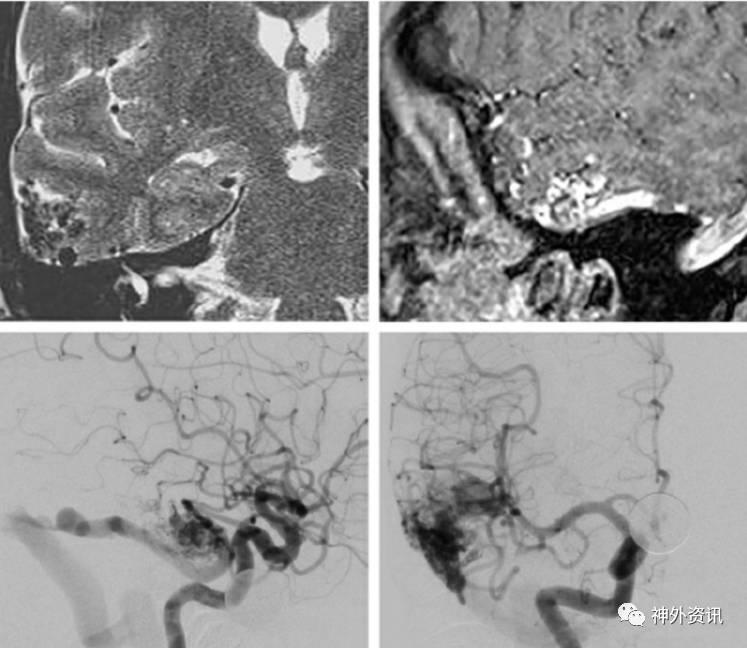 颞叶动静脉畸形(avms)手术技巧 | the neurosurgical