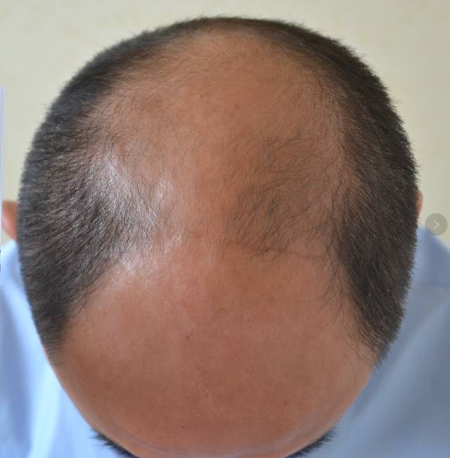 秃顶20年,28天长出新发?刮周围头发能生发?真相是