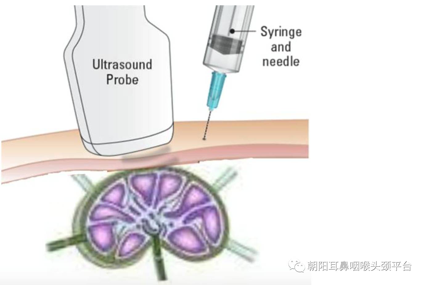 颌下淋巴结肿大怎么办