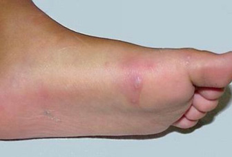 5,手,足等远端部位出现或平或凸的斑丘疹或疱疹,初起为斑丘疹,后转变
