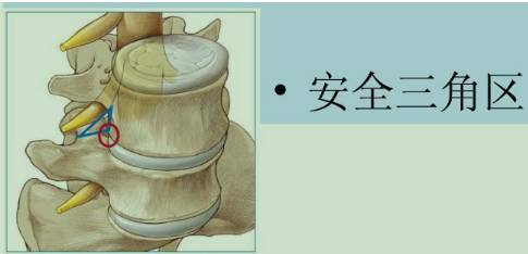 新华医疗cmef新品发布回顾|椎间孔镜专用手术器械