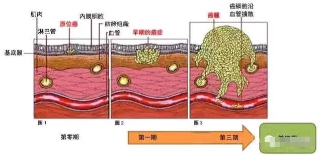 癌症 控制人口_癌症图片(3)