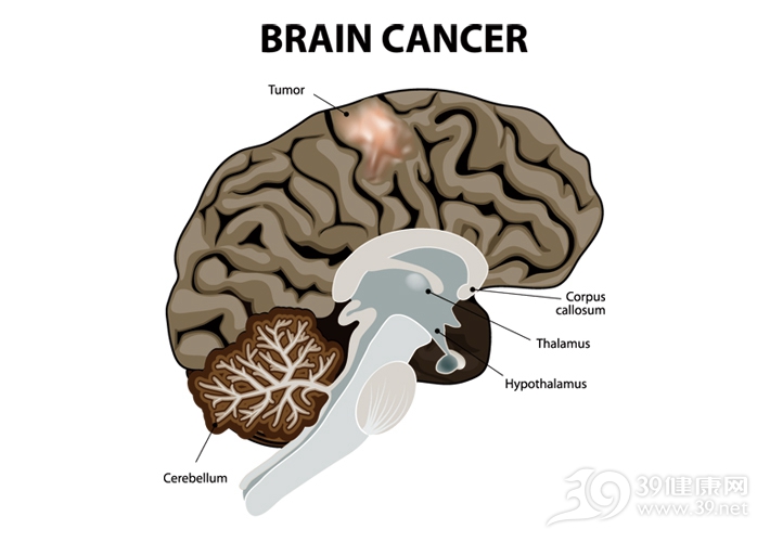 临床上把脑胶质瘤分为四个级别Ⅰ级是良性胶质瘤Ⅱ级是恶性度较低