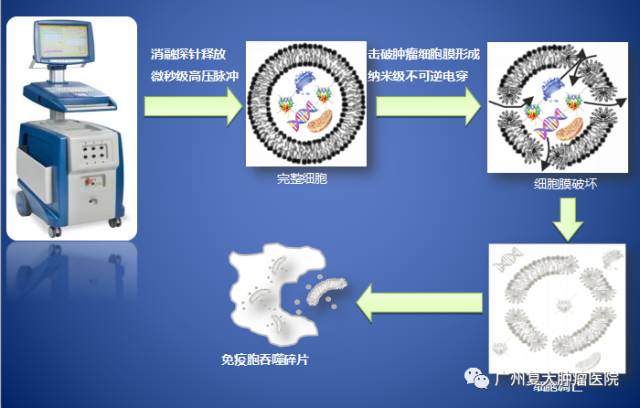 重磅纳米刀技术首次被写进nccn指南