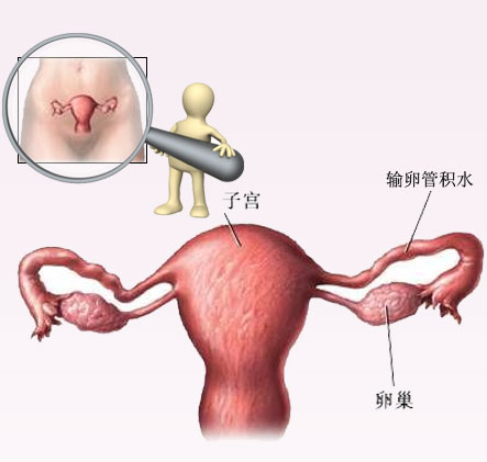 中医讲解放环后引起的月经不调