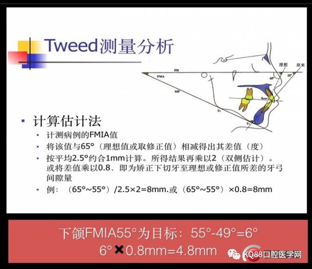 跟踪了三年的安氏二类一分类患者