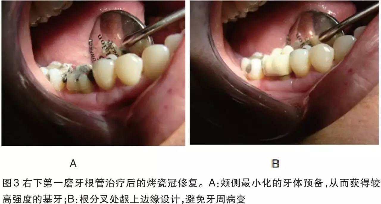 如果患牙有根面或根分叉的暴露而无龋坏等,建议使用龈上无角肩台(图3