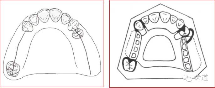 可摘局部义齿的肯氏(kennedy)分类及设计