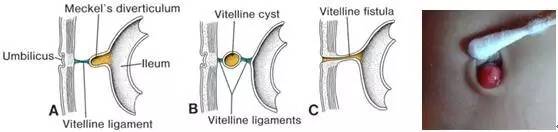 5,脐茸:如果卵黄管完全闭塞,仅在脐部残留粘膜组织,就会形成鲜红色的