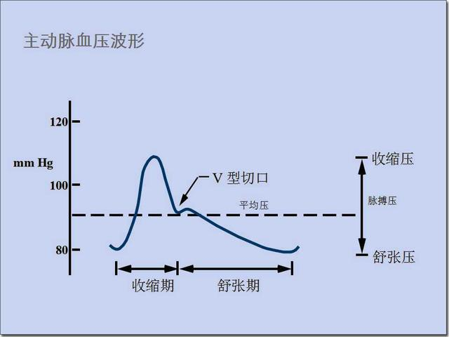 何为主动脉内球囊反搏术iabp