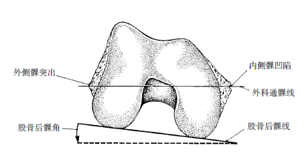 图4-1 外科通髁线及股骨后髁角
