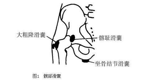 那么你的髋关节可能发生了滑囊炎