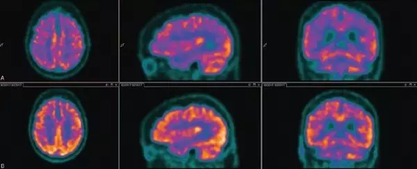 谵妄的突破性研究,可能解决2500年的医学之谜