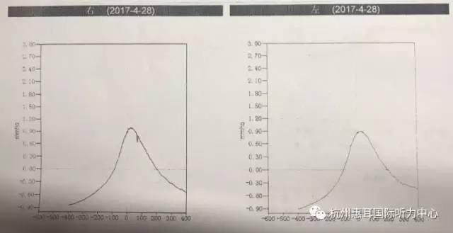 大庆网 时事新闻 国内 同月医院的检查报告如下 1,声导抗:左右耳均为