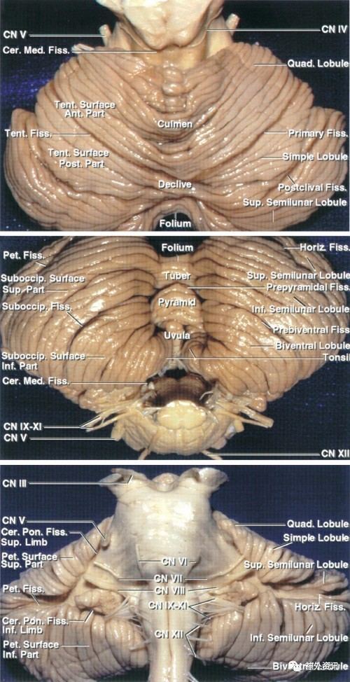 小脑动静脉畸形手术技巧 the neurosurgical atlas全文翻译