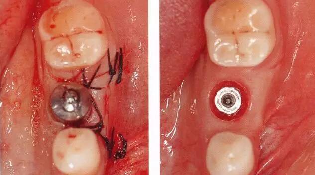 【种植与牙周组织】种植体周围角化龈的获得时期与方法