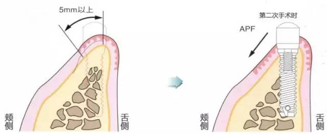 【种植与牙周组织】种植体周围角化龈的获得时期与方法