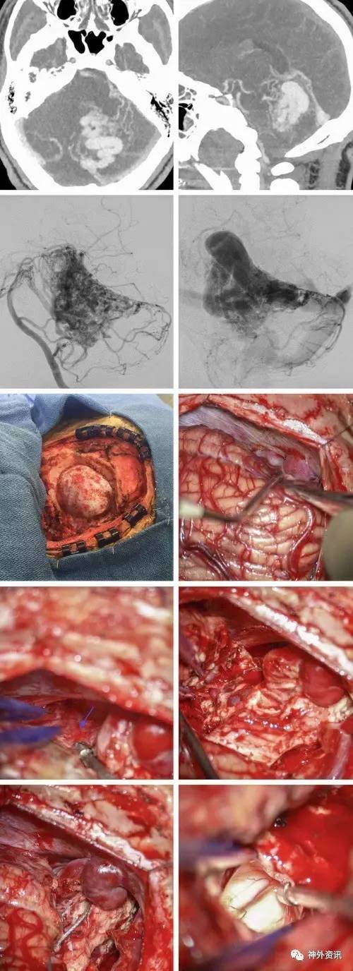 小脑动静脉畸形手术技巧 the neurosurgical atlas全文翻译