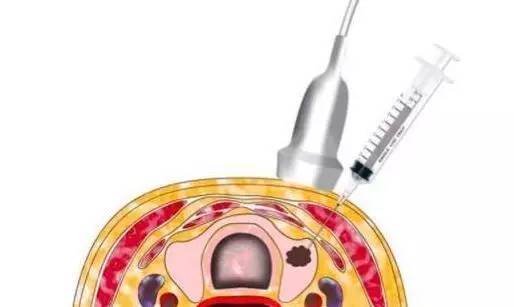 提示| 世界上最动听的语言不是"我爱你",而是在穿刺活检后医生告知"你