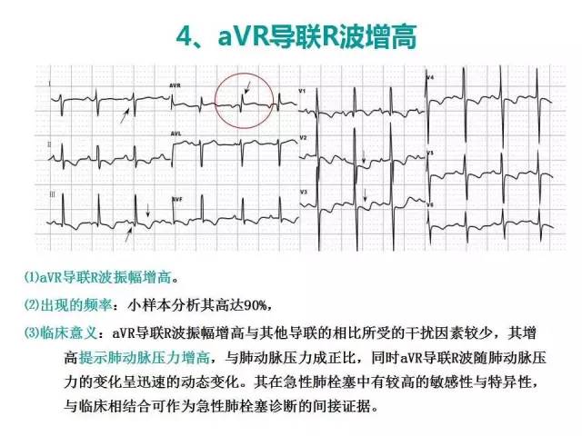 健康 正文  avr导联除能较准确地反应肺动脉压的高低,还对肺栓塞患者