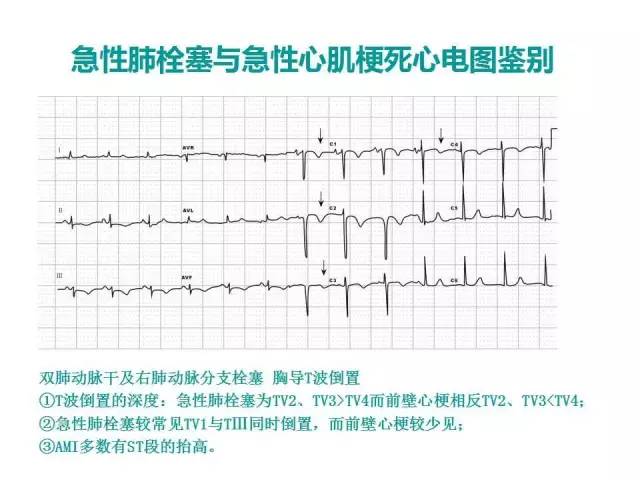 典型的肺栓塞,不典型的心电图