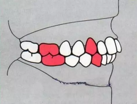正常牙齿排列是这个样子,看看你的是否正常?