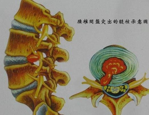 按照这个法子治腰间盘突出,让你花小钱治大病