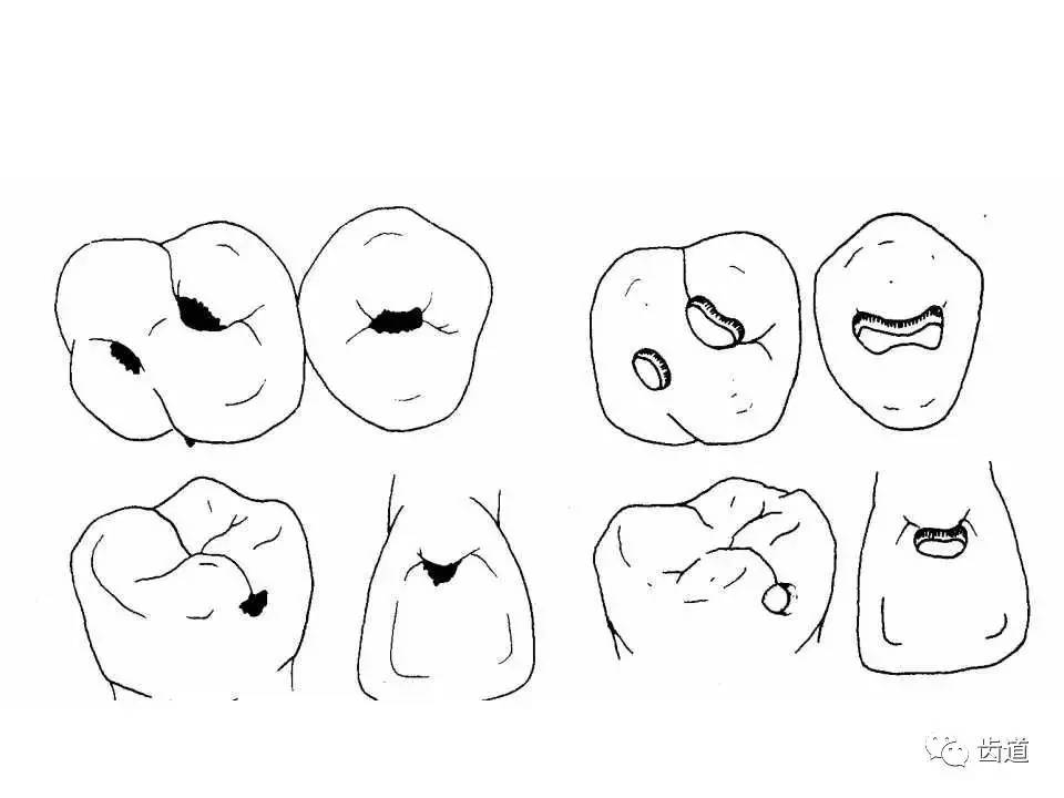 龋洞经手术制备后形成的洞形一,窝洞:四,窝洞消毒药物同氨硝酸银,也可
