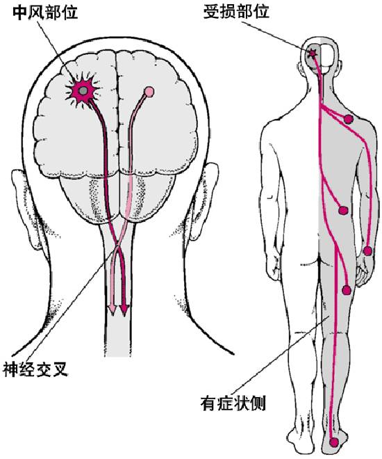 中风病人口吐黑褐色物