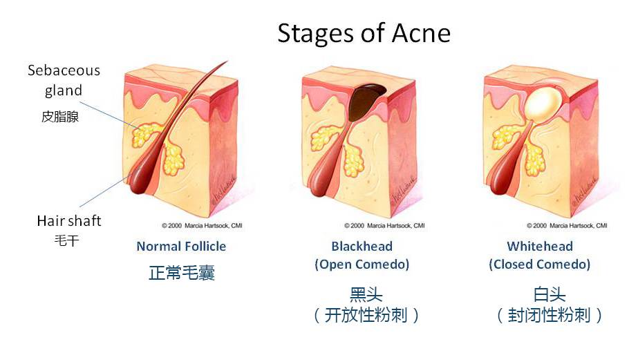 黑头鼻贴原理是什么_黑头是什么样子图片(2)
