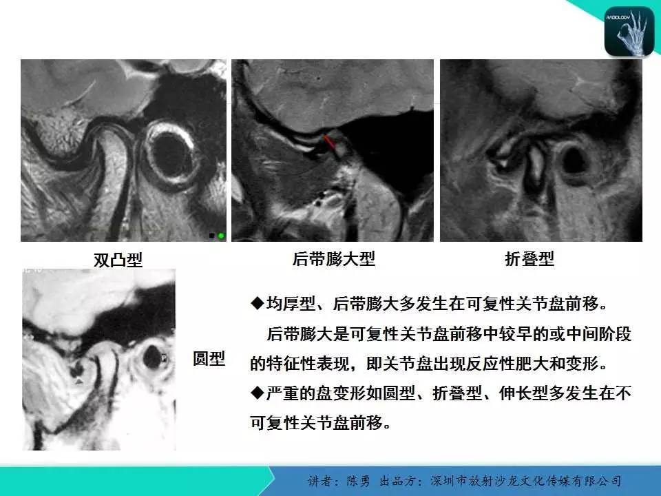 【专家大讲堂】颞下颌关节紊乱的mri诊断