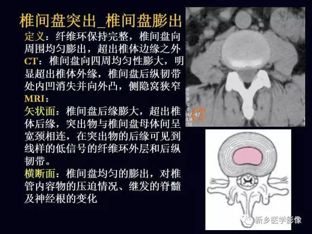 一文读懂椎间盘突出的解剖要点