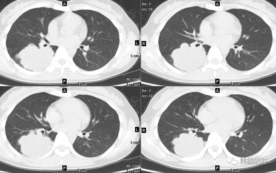 【每日一例 | 385期】25岁女性,咳嗽2月,行胸部ct扫描
