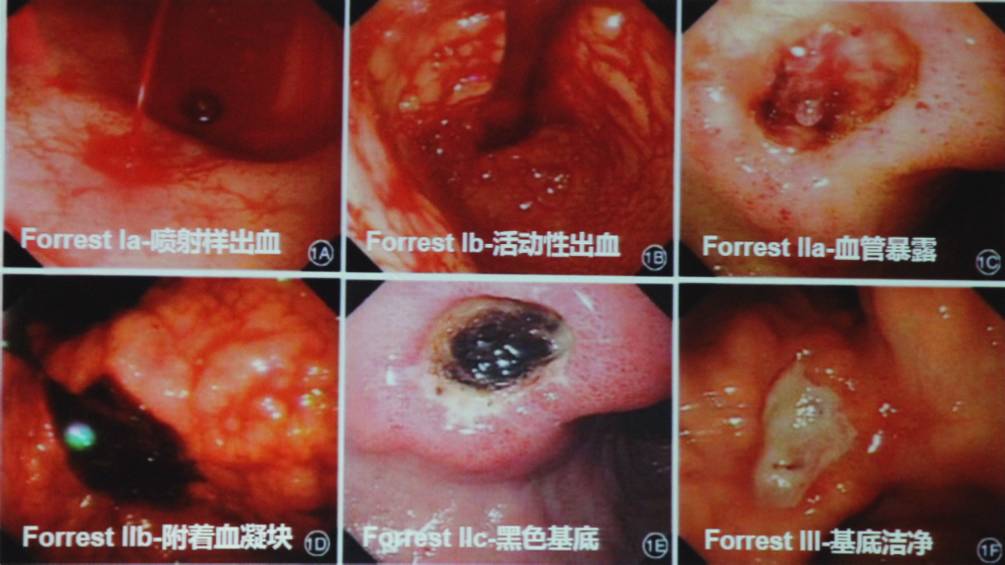 4张评分表,教你合理评估acs合并上消化道出血