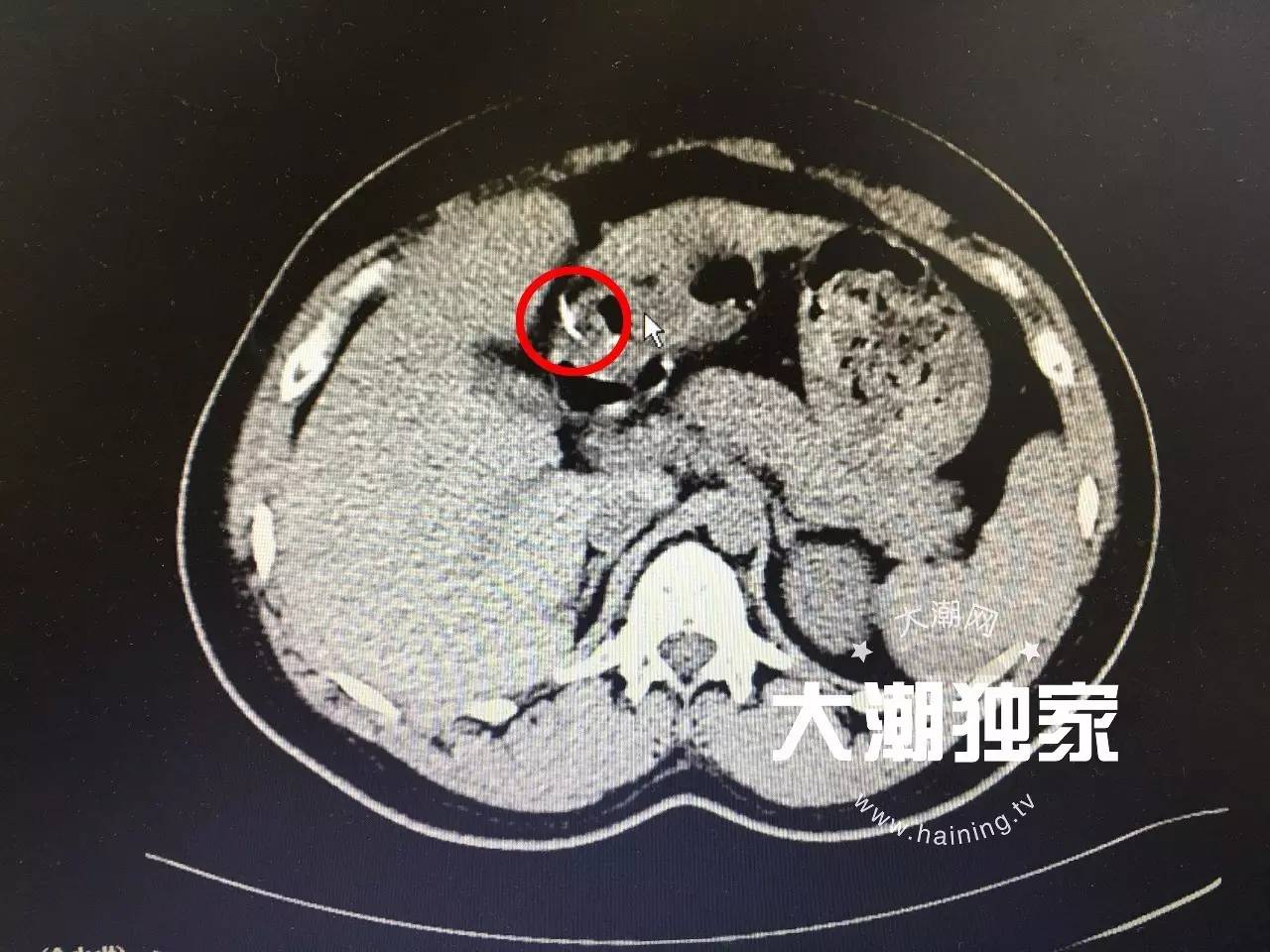 闻医生建议她先去做一个ct扫描,检查结果竟然是胃穿孔!
