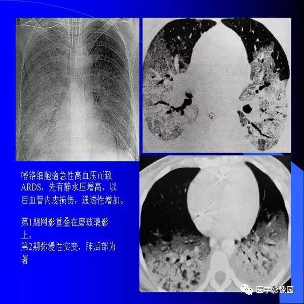 肺水肿的影像学表现