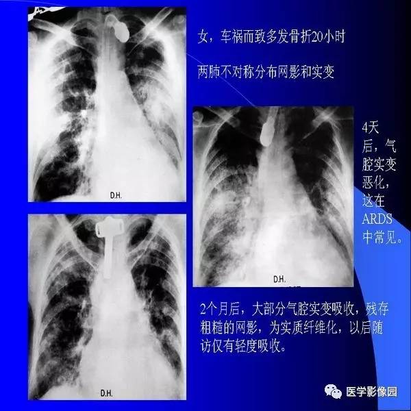 肺水肿的影像学表现