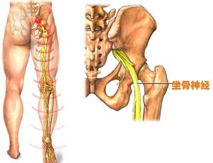 颈椎病和坐骨神经痛能否治愈?日常生活中需要注意什么?