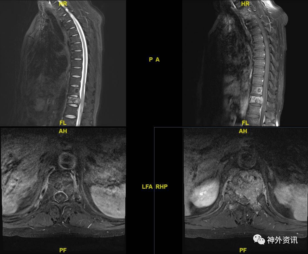 典型病例：脊髓髓内室管膜瘤的微创手术切除，全切治愈！ - 微医（挂号网）