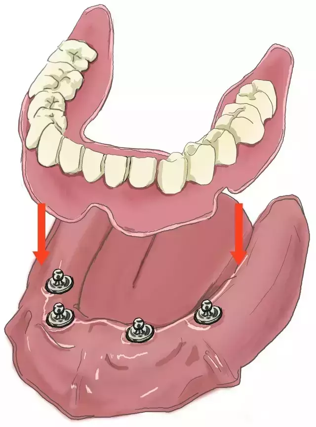 图解关于种植牙,你最想知道的事!