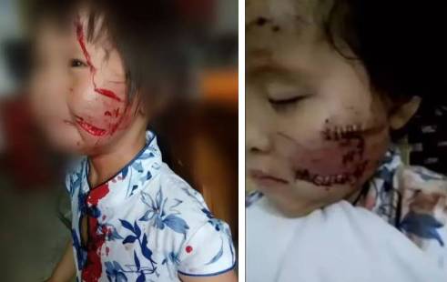 痛心!儿童节前梅州5岁女童被咬烂半张脸