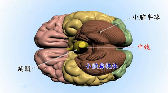 持续颈肩肢体疼痛并伴眩晕感应警惕小脑扁桃体下疝