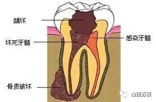 蛀牙破了一半怎么办