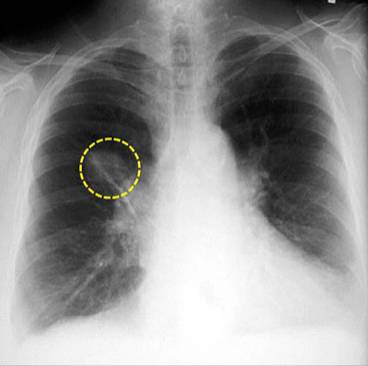 肺部炎症影像诊断