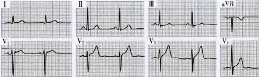 siqⅢtⅢ征消失,以右胸导联为主的t波倒置恢复正常daniel心电图评分