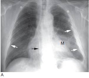 肺癌的影像学表现上多图