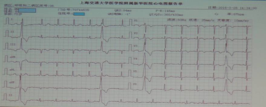 患者入院次日的心电图:siqⅢtⅢ征,Ⅱ,Ⅲ,avf,v1-v6t波广泛倒置,qt