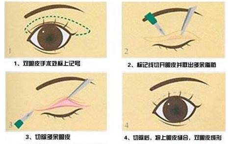 做到这几点,割双眼皮后不易被看出来