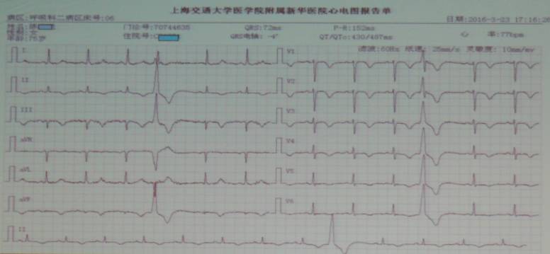 患者入院次日的心电图:siqⅢtⅢ征,Ⅱ,Ⅲ,avf,v1-v6t波广泛倒置,qt