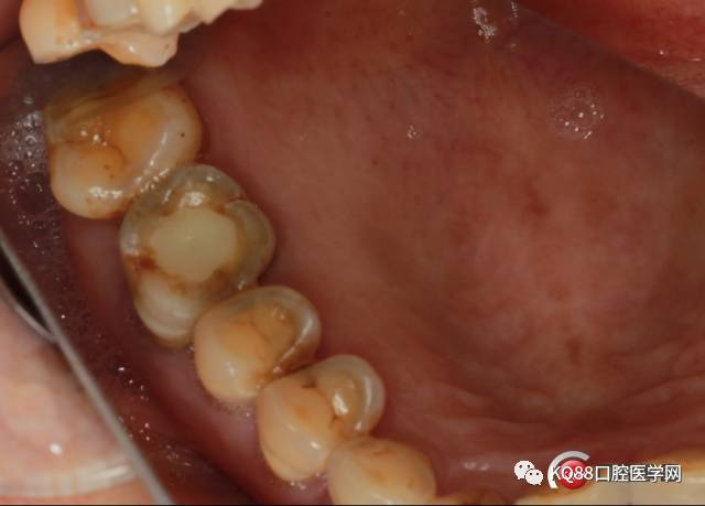 26日牙周复查,患者自述无不适 检查:口腔卫生尚可,牙龈炎症明显减轻